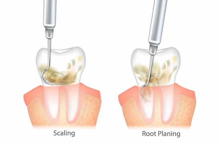 scaling and root planing at lexington dental of owasso