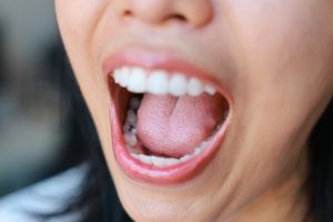 close up image of woman's mouth with tooth decay