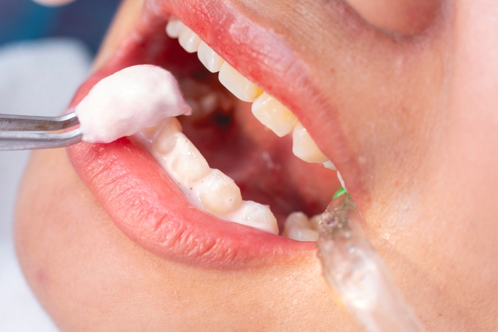 fluoride applications