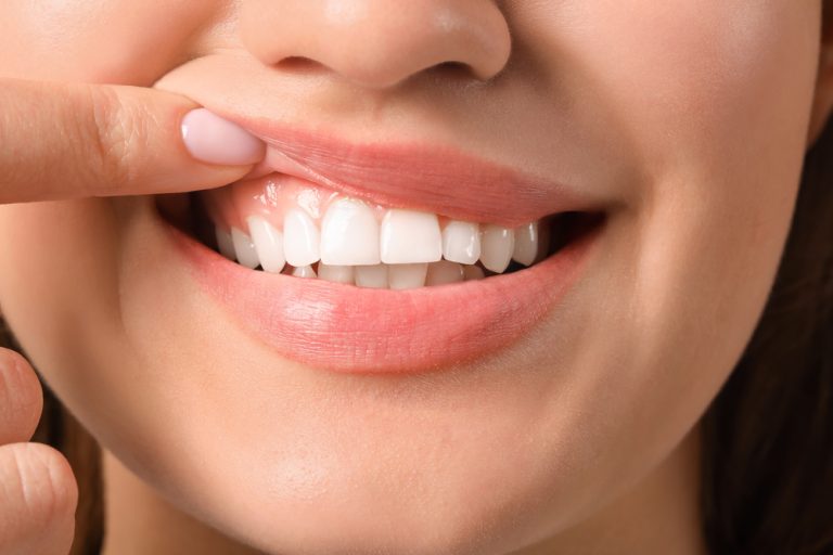 woman showing her mouth and gums