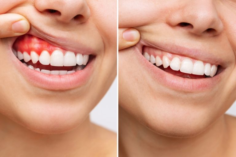 gum disease before and after treatment