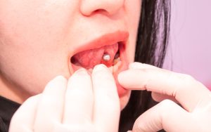 oral piercing and your teeth