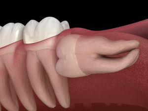 horizontal impaction, wisdom tooth