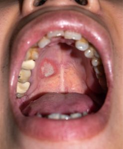 persistent mouth sore may indicate oral cancer
