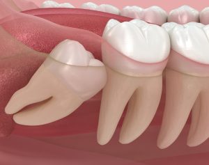 angled impaction, wisdom tooth