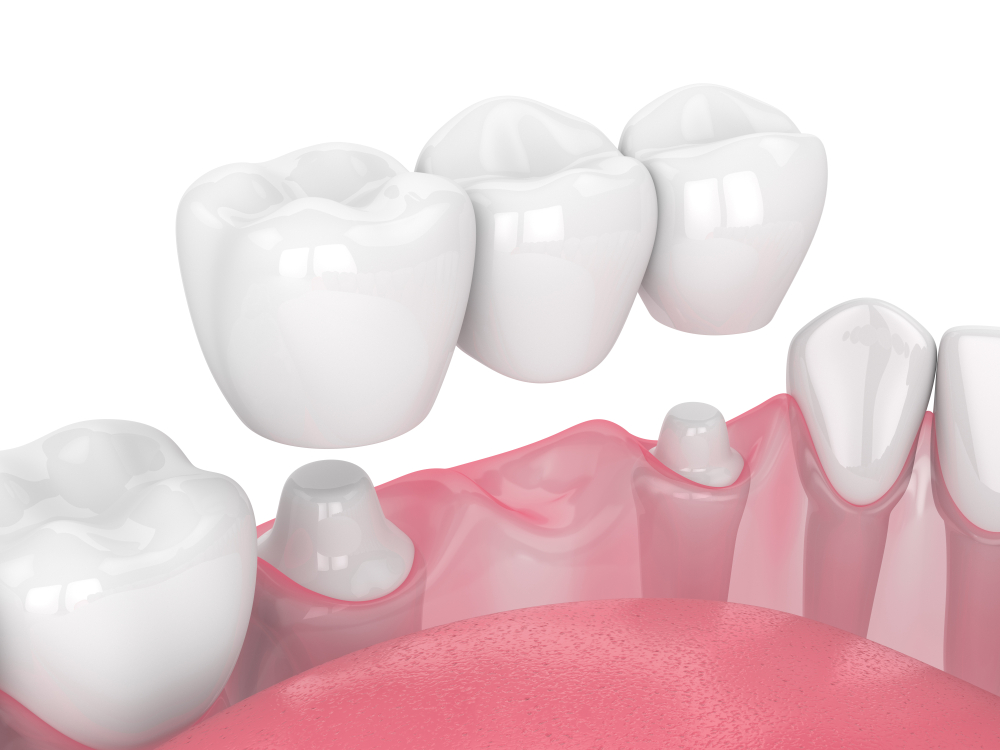 dental bridge attached to teeth