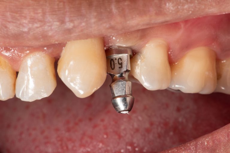 dental implant