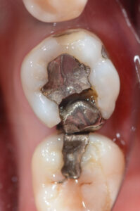 Close-up of a dental crown and amalgam filling in a tooth, highlighting potential signs of wear and the importance of monitoring dental restorations for effective oral health.