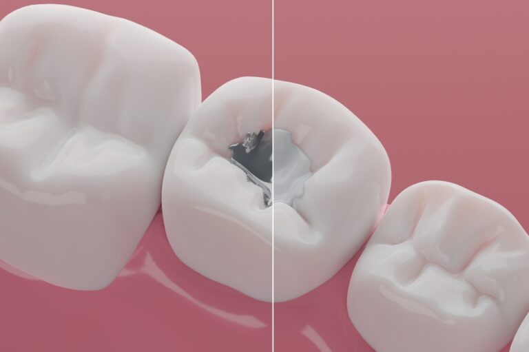 Close-up of three teeth, one with a dental filling, illustrating the effects of tooth decay and the importance of dental care.