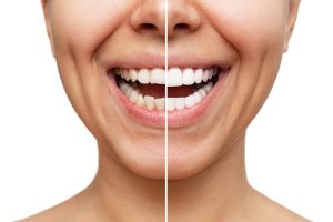 Before and after comparison of a woman's smile showcasing the transformative effect of porcelain veneers, highlighting natural-looking, white teeth on the right side.