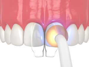 Dental bonding procedure demonstrating tooth-colored resin application to teeth for cosmetic enhancement, addressing issues like chips and gaps.
