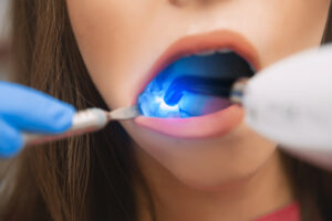 dentist curing dental filling