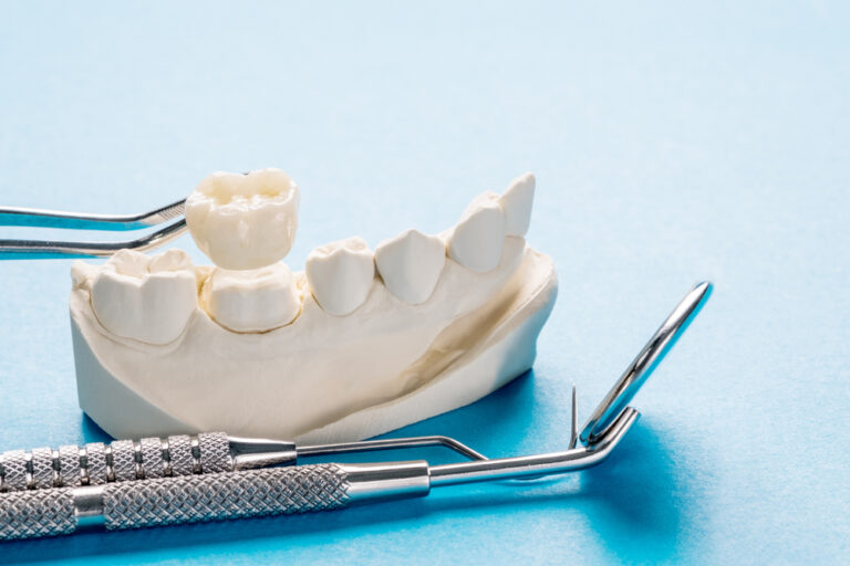 traditional dental crown
