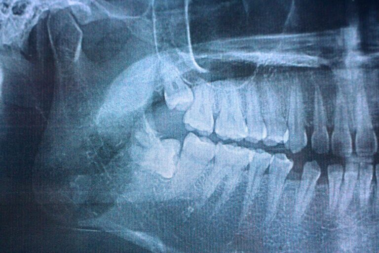 wisdom teeth x-ray