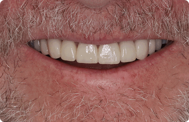 After image