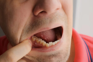 Man examining gum bump, possible dental fistula symptom