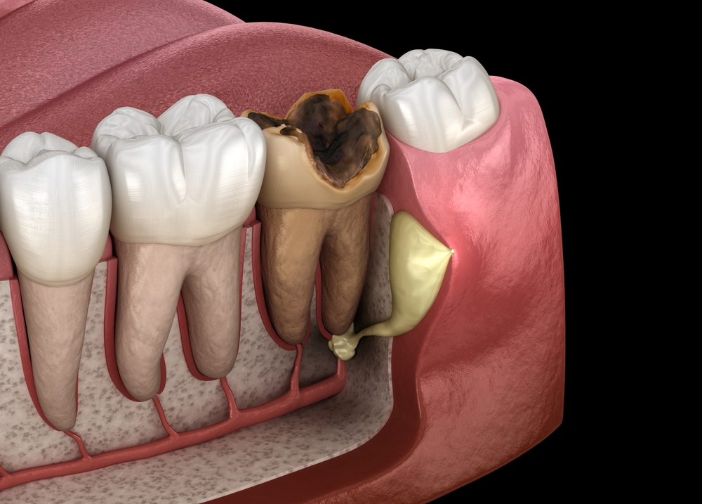 dental fistula
