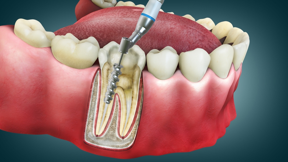 root canal therapy cavity treatment