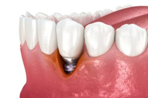 gum recession from implant failure