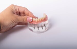 all on 4 dental implants