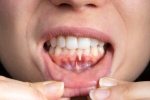 gum disease with gum recession