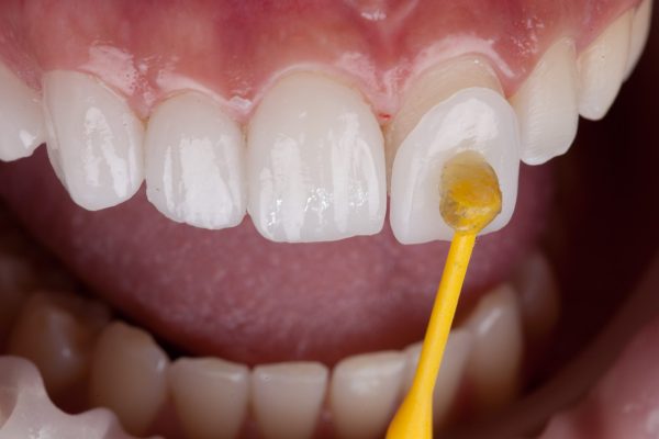 Close-up of a dental professional applying adhesive to a porcelain veneer on a front tooth, showcasing the process of cosmetic dentistry for smile enhancement.