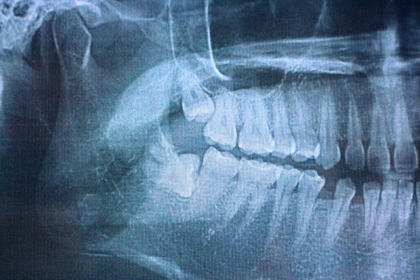 Panoramic,Radiograph,Of,Multiple,Tooth,Impaction,In,Upper,And,Lower wisdom teeth impaction