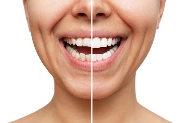 Before and after comparison of a smiling woman showcasing the transformation of her smile with dental veneers, highlighting the aesthetic improvement and confidence boost from cosmetic dentistry.