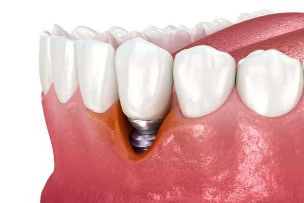gum recession from implant failure
